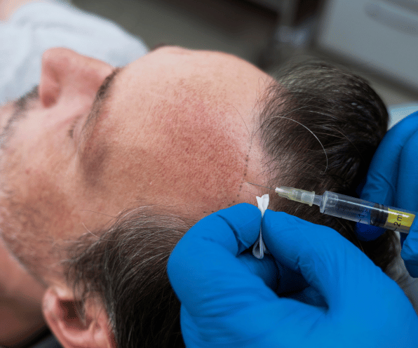 Hair PRP Treatment - Regrow Hair Naturally at Aesthetic & Wellness Clinic